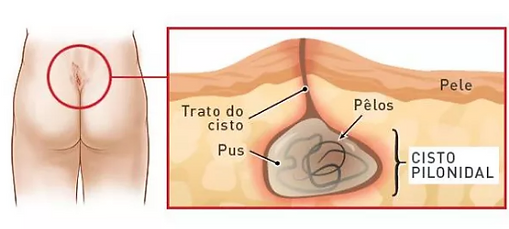 Imagem de dois desenhos. Na primeira à esquerda, mostra a região dorsal de uma pessoa com uma pequena lesão acima do glúteo, no coócix. Essa lesão está representada no desenho ao lado, que apresenta a pele, a derme com o cisto pilonidal na forma de cápsula com pêlos e pus dentro, com a cápsula fazendo comunicação com a pele através do trato do cisto.