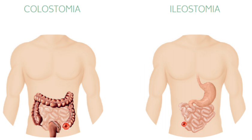 Apresenta dois desenhos. O primeiro, à esquerda, possui a representação de um tórax com o abdome com o retrato do intestino sendo destacado o intestino grosso e a estomia em sua porção final. No desenho à direita, está representado o tórax e o abdome, com a figura do estômago e intestino delgado e uma porção desse órgão com a extremidade com estomia.