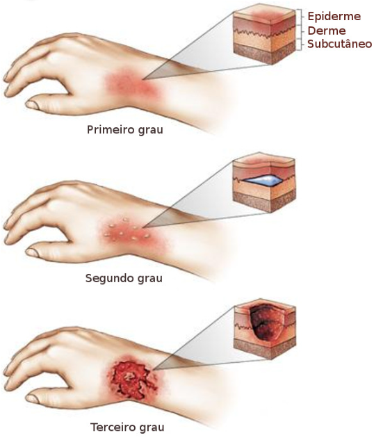 Imagem composta de três desenhos representando uma mão com queimadura. A primeira figura representa uma mão com uma área vermelha, com descrição de primeiro grau. A segunda imagem é uma mão com área vermelha e pequenas bolhas, que representa a de segundo grau e o último desenho representa a mão com uma lesão mais profunda que representa uma queimadura de terceiro grau.
