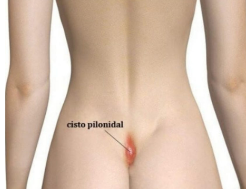 Desenho de uma pessoa de costas com a representação do cisto pilonidal na região sacral com coloração avermelhada.