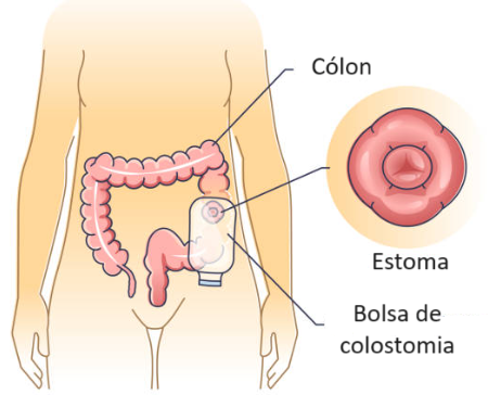 Corpo humano desenhado, representado o intestino grosso. Possui uma parte do órgão, o cólon, que está segmentado, exteriorizando sua porção, que é denominado estoma. Nele está aderido a bolsa de colostomia.