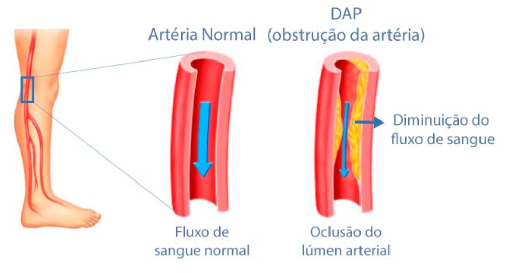 Desenho representado um vaso sanguíneo sem alterações, com fluxo de sangue normal. E outra imagem ao lado com o vaso sanguíneo com oclsão parcial do vaso, demonstrando uma diminuição do fluxo sanguíno que representa a Doença Arterial Periférica.