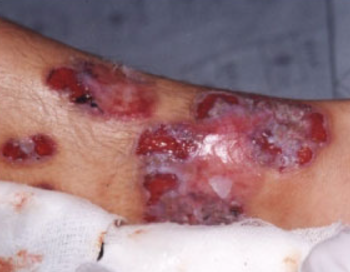 Foto de uma lesão de pioderma gangrenoso, na perna. Possuoi várias feridas, com bordas violáceas, leito com parte de necrose e tecido de granulação.