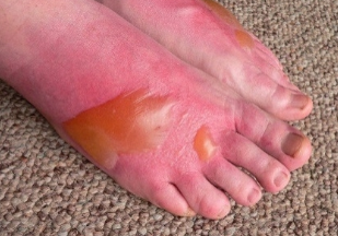 Foto dos pés com queimadura de 2º. Pés se encontram com bolhas e vermelhos.