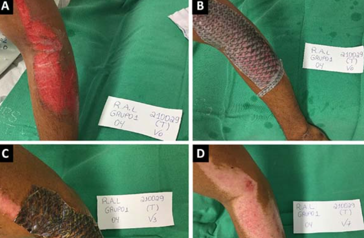 Foto de um braço em quatro etapas de evolução. A imagem A mostra a pele com queimadura. B: Curativo com a pele da Tilápia-do-Nilo no 1º atendimento clínico . C: Avaliação do curativo após 7 dias; D: Completa reepitelização da ferida após 16 dias.