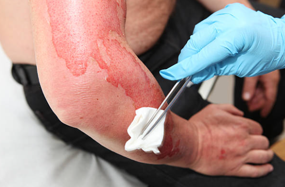 Imagem de uma ferida no braço  e antebraço, que está sendo limpa com ajuda de uma pessoa usando luva cor azul com auxílio uma pinça e gaze sobre a lesão, promovendo a limpeza.
