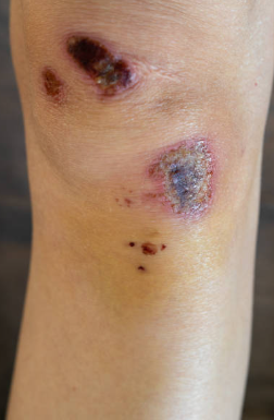 Ferida em um joelho com necrose, uma tecido preto, e esfacelo, um tecido amarelo sobre a lesão. 