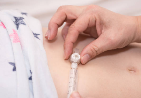 Imagem de uma pessoa cor branca com dispositivo de gastrostomia, chamado Boton. Possui na imagem duas mãos que manuseam o dispositivo, uma mão segundo o boton e outra mão aclopando uma seringa.