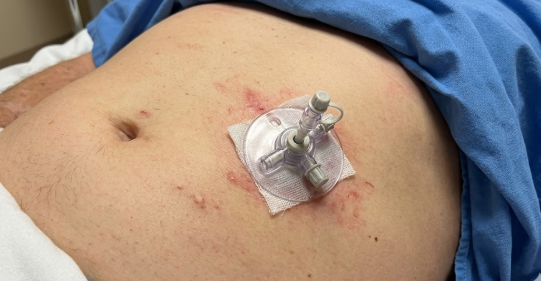 Foto de uma pessoa cor branca, deitada, com uma gastrostomia. Possui irritação da pele ao redor e uma gaze entre o dispositivo e a pele.

