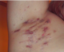 Imagem de uma axila com várias áreas de coloração avermelhada e áreas de cicatrizes.