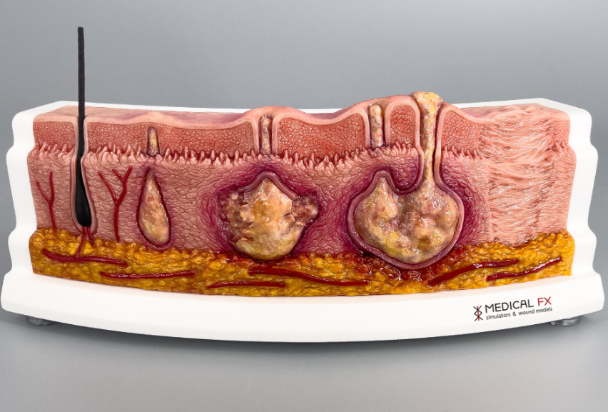Imagem do processo fisiológico da hidradenite supurativa. A imagem representa uma foto cortada da pele, com exposição do tecido subcutâneo, derme e epiderme. Na derme há o entupimento do folículo piloso, com surgimento do abcesso, no qual é representado na imagem ao lado com o folículo piloso inflamado, com abcesso envolvido e com drenagem através da epiderme.