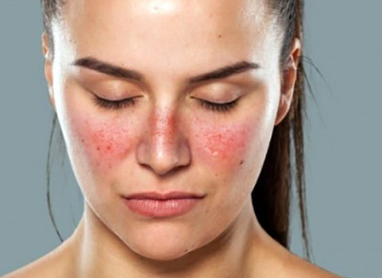 Mulher, cor branca, com ohos fechados, com uma coloração avermelhada nas bochecas que se conectam uma a outra, com formato de uma borboleta.