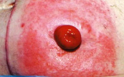 Dermatite de contato alérgica periestomal. A pele ao redor da estomia apresenta vermelhidão intensa e inflamação, que podem estar relacionadas à reação aos componentes da base adesiva, barreiras protetoras ou outros produtos utilizados nos cuidados com a estomia.