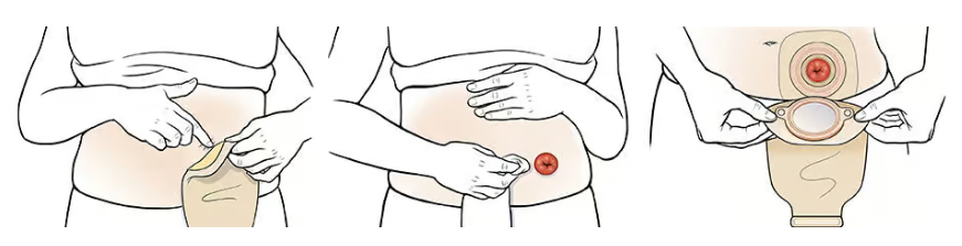 Passo a passo da troca da bolsa de colostomia, com limpeza do estoma e colocação correta da bolsa coletora para proteger a pele ao redor da estomia.