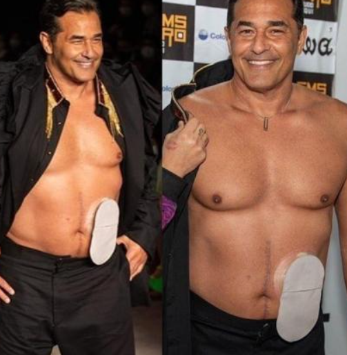 Montagem com duas fotografias de um homem utilizando uma bolsa de colostomia. As imagens ilustram que pessoas com estomia podem manter uma vida ativa, participar de eventos públicos e conviver socialmente.