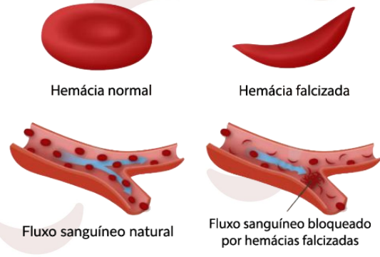 Desenho representativo de uma hemácia saudável, redonda e com fluxo sanguíneo natural. Possui outra hemácia ao lado em formato de foice ou meia lua e com o fluxo sanguíneo obstruído devido ao seu formato, caracterizando a anemia falcifrme.
