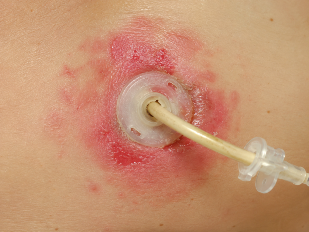Imagem ilustrativa de dermatite periestomal ao redor de uma gastrostomia, com vermelhidão intensa, irritação da pele e áreas de erosão ao redor da sonda de alimentação.