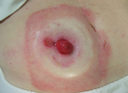 Fotografia clínica de uma dermatite periestomal em paciente com estoma intestinal. Observa-se uma área extensa de vermelhidão e irritação da pele ao redor do estoma, compatível com lesão causada pelo contato da pele com o efluente intestinal ou por falhas na vedação da bolsa coletora.