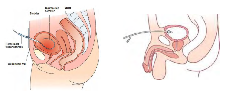 Ilustração anatômica da cateterização suprapúbica em corte sagital do aparelho urinário feminino e masculino. À esquerda, o cateter suprapúbico atravessa a parede abdominal e é introduzido diretamente na bexiga por meio de um trocarte, na figura feminina. À direita, no masculino, o cateter vesical de demora está inserido na bexiga. A imagem destaca o trajeto do dispositivo para drenagem urinária.