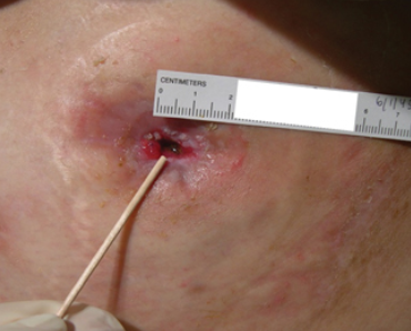 Fotografia clínica de um estoma com estenose, evidenciando o estreitamento da abertura estomal. A imagem demonstra a avaliação do calibre do estoma com um instrumento, utilizada para confirmar a redução do diâmetro da abertura.