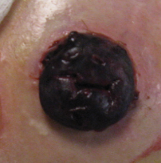 Fotografia clínica de um estoma com necrose, evidenciando coloração preta compatível com comprometimento do fluxo sanguíneo do tecido intestinal.