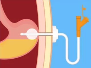 Ilustração mostrando uma sonda de gastrostomia inserida diretamente no estômago através da parede abdominal para alimentação enteral.