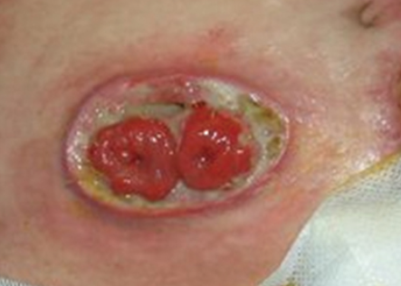 Fotografia clínica de um descolamento mucocutâneo em um estoma intestinal. Observa-se a separação entre a mucosa do estoma e a pele ao redor, com presença de tecido de granulação e áreas de esfacelo.