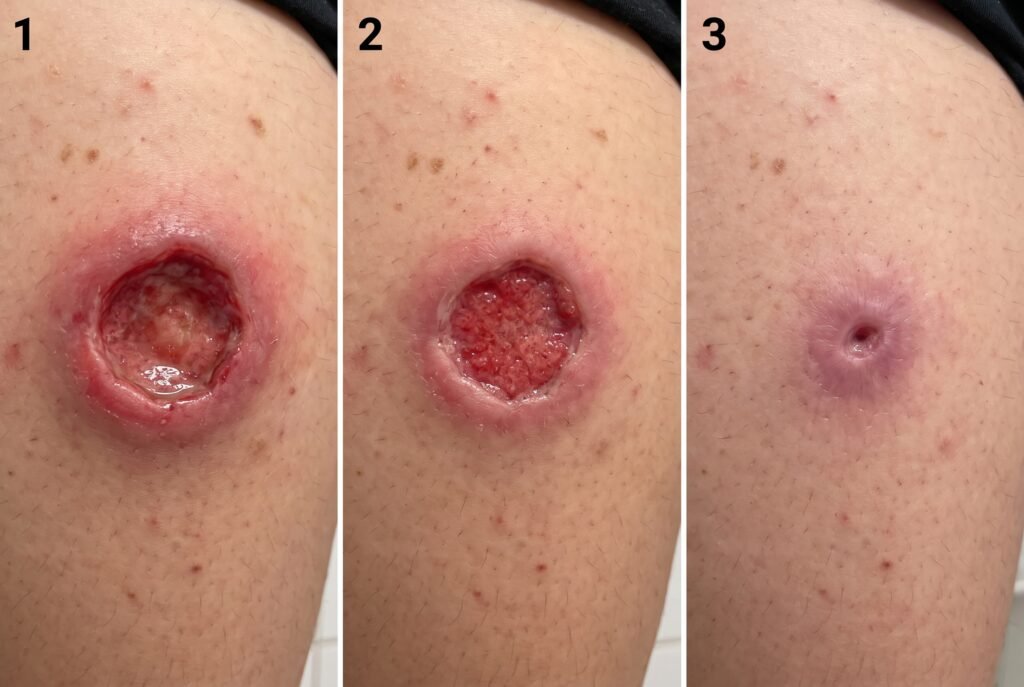 Sequência de três fotos lado a lado mostrando as fases da cicatrização por segunda intenção de um furúnculo na coxa. O quadro 1 mostra uma ferida arredondada, profunda e úmida. O quadro 2 mostra a ferida mais rasa, com o fundo preenchido por tecido vermelho de granulação. O quadro 3 mostra a ferida quase totalmente fechada e nivelada à pele, restando apenas uma pequena abertura central cercada por uma pele de tom rosado/arroxeado.