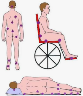 Ilustração anatómica de um mapa de pontos de pressão no corpo humano, destacando as áreas de maior risco para o desenvolvimento de úlceras por pressão em três posições: visão dorsal, paciente sentado numa cadeira de rodas e paciente deitado em decúbito lateral.