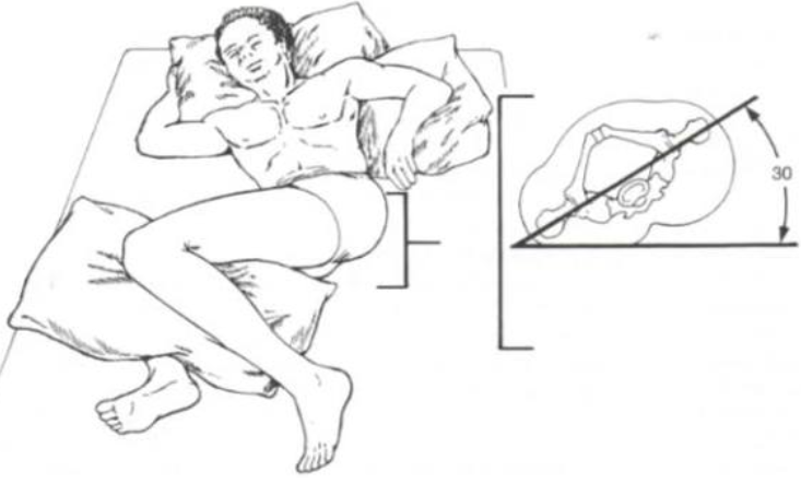 Ilustração de um paciente deitado na posição de decúbito lateral a 30 graus. A imagem mostra o uso de travesseiros sob a cabeça, entre as pernas e atrás das costas para manter a postura, acompanhada de um diagrama que detalha o ângulo de 30 graus da pelve em relação ao colchão.