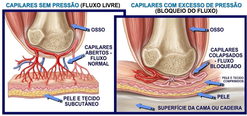 Do lado esquerdo, observamos uma área sem excesso de pressão, onde a circulação é saudável e o sangue flui livremente para nutrir a pele e o tecido subcutâneo. Já do lado direito, vemos o cenário crítico: quando há imobilidade, o peso do corpo faz com que o osso comprima os tecidos contra uma superfície rígida (como o colchão ou o assento de uma cadeira). Essa pressão excessiva e contínua colapsa os vasos capilares. Sem o fluxo sanguíneo adequado, a região deixa de receber oxigênio e nutrientes essenciais (um processo chamado isquemia), o que resulta na morte celular e na consequente formação da lesão por pressão.