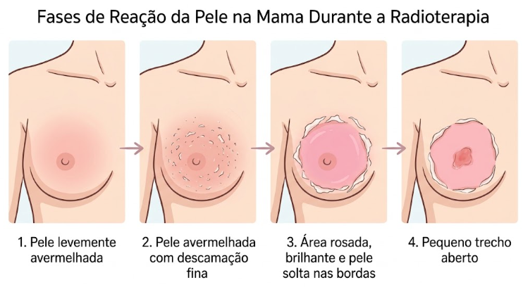  ilustração didática, não fotografia, em quatro quadros lado a lado mostrando a mesma área de pele em fases: pele levemente avermelhada; pele avermelhada com descamação fina; área rosada e brilhante com pele solta nas bordas; e um pequeno trecho aberto. Traço suave, sem sangue. O objetivo é a pessoa reconhecer em que fase está.